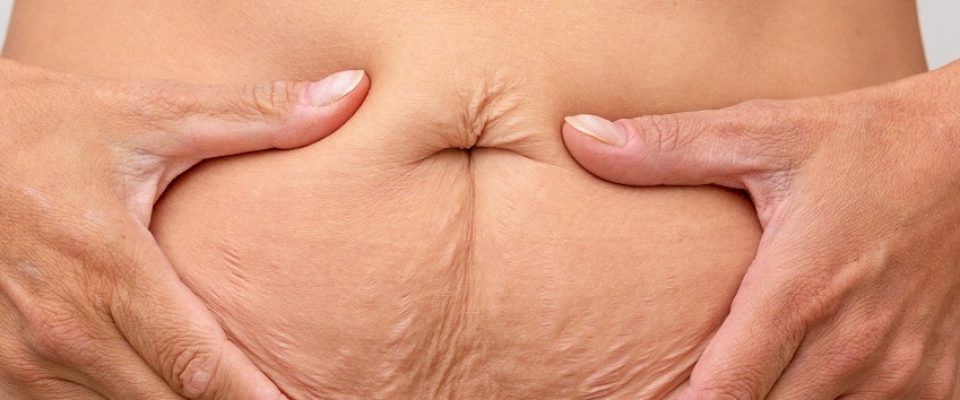 Bauchstraffung bei überschüssiger Haut